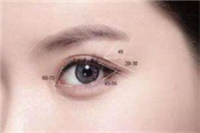 去韩国修复全切双眼皮哪家医院技术更好