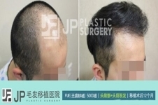韩国JP医院毛发移植怎么样？手术费用贵不贵？