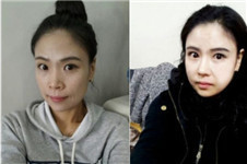 在韩国现代美学脂肪填充+鼻综合整形后年轻十岁