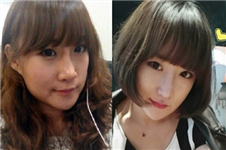 韩国ID医院Vline下颌角+芭比鼻整形真人案例3个月恢复过程
