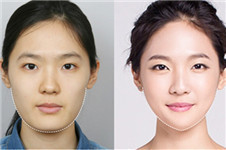 NJH卢钟勋医院下颌角VS德莱茵3D下颌角哪家瘦脸效果更好？