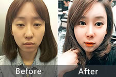 韩国加美做眼鼻整形+面部脂肪填充效果怎么样？