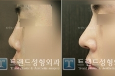 韩国trend医院鼻子整形怎么样？术后效果自然吗？