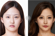 韩国原辰与topclass整形外科医院假体隆鼻特色对比