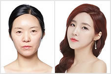 韩国秀美颜面部整形真实案例，从大妈变成女神