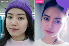 韩国A特整形医院下颌角手术效果好不好，有没有日记对比？