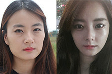 韩国珠儿丽整形医院下颌角整形是网红风吗？技术怎么样？
