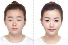 韩国希克丽与玛博尔整形医院双眼皮手术差异对比