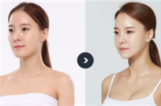韩国女生在JAYJUN整形外科做下颌角整形后变V脸童颜美女