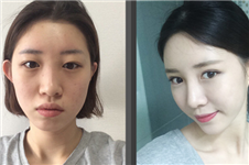 韩国omega医院眼鼻整形+脂肪填充+vline术后两个月记录