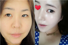 韩国ID整形外科医院提眉+面部提升 年轻到20岁