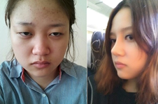 韩国AHN医院安晟凤院长做隆鼻手术特点有哪些？
