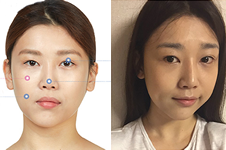 韩国JAYJUN医院做轮廓+眼鼻整形手术真人案例展示！