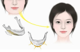 韩国美护恢复指南：面部轮廓术后护理注意事项！（二）