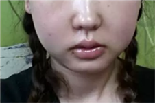 韩国原辰整形医院双鄂修复术，还原完美脸型！