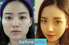 韩国灰姑娘整形医院鼻部整形效果怎么样？了解一下
