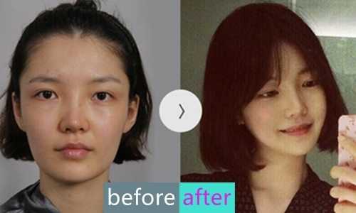 真人分享：韩国麦恩整形外科面部轮廓三件套效果惊人