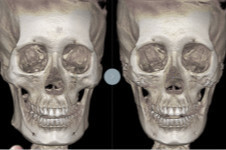 解析：DA医院面部轮廓整形手术特点+案例分析！