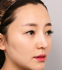 韩国然美之鼻梁+鼻尖+驼峰鼻整形案例
