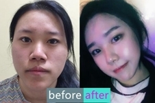 韩国cbk整形外科崔凤均双鄂手术，第一眼美女养成记