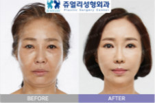 韩国珠儿丽面部提升手术价格是多少，效果如何？