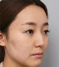 韩国然美之整形外科-韩国然美之鼻梁+鼻尖+驼峰鼻整形日记