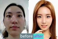 韩国美之爱整形外科面部轮廓手术，轻松变脸，贼好看