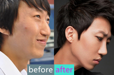 韩国POP整形外科鼻综合手术，让我也可以用鼻子点赞高考
