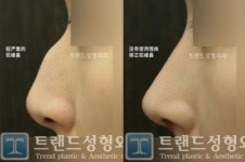 韩国trend和4月31做自体耳软骨隆鼻怎么样，术后效果自然吗？