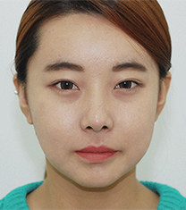 韩国齐娥牙科姜永浩正颌手术前后对比图