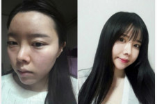 韩国仿生隆鼻可以永久吗，有没有后遗症？