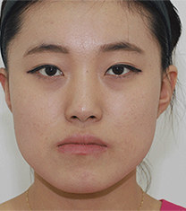 韩国齐娥牙科姜永浩正颌手术前后对比图_术前