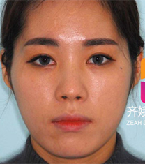 韩国齐娥牙科轮廓手术缩颧骨前后对比案例