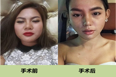 韩国ID医院孙元一V-LINE瓜子脸+鼻修复手术，侧颜无敌超上镜