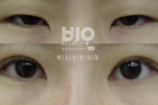 揭秘：韩国BIO医院洪星杓双眼皮修复手术真实案例
