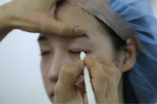 韩国eve院长郑润载修复内眼角手术有没有后遗症？