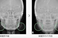 韩国原辰下颌角失败修复手术有没有真人案例？