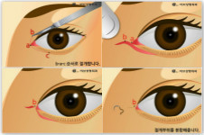 韩国eve修复内眼角靠谱吗，修复后图片案例大全！