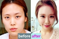 韩国灰姑娘整形医院自体脂肪全脸填充后，秒变清新处女脸