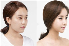 韩国肋软骨隆鼻与耳软骨隆鼻价格差异，哪种隆鼻效果好