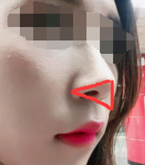  韩国nplus整形医院做鼻子真实案例