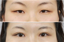 做韩式双眼皮医院，韩国有哪些比较出色？