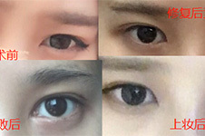 你知道韩国eve修眼角价格多少钱吗？内外眼睛案例图分享！