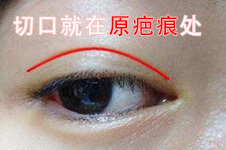 双眼皮疤痕修复怎么才彻底，疤痕贴、激光效果都不一定好