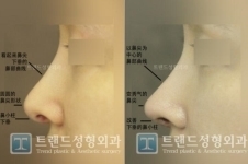 韩国trend整形医院做鼻子怎么样，案例效果如何？