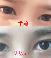  韩国eve修复内眼角前后照片案例