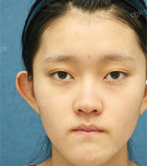 韩国CBK整形外科-韩国cbk轮廓整形双鄂手术案例图片