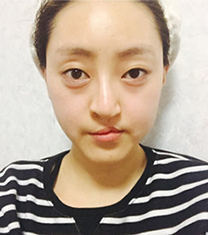 韩国cbk兔唇唇腭裂修复案例前后照片