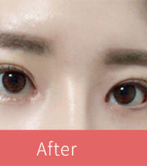 韩国普瑞美张裕珍双眼皮+眼型矫正+开眼角案例图