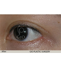 韩国GIO整形医院眼尾外露修复前后照片